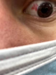 A close-up of my eye showing some broken vessles